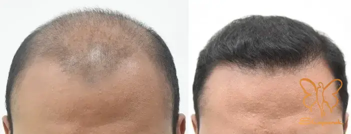 تأثیر تزریق پی آر پی بر رنگدانه مو ملانین تأثیر تزریق پی آر پی بر رنگدانه مو ملانین