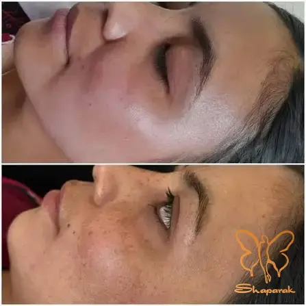 پاکسازی تخصصی پوست مشهد پاکسازی تخصصی پوست مشهد