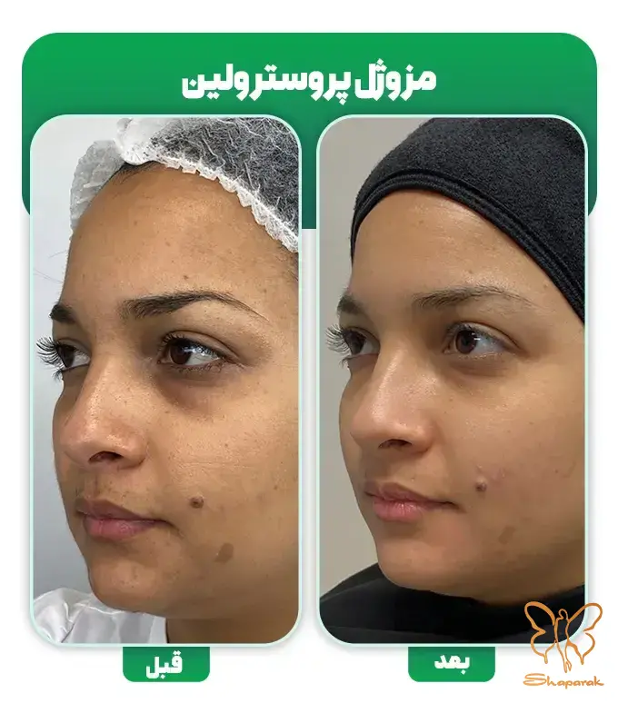 مزوژل پروسترولین بلنک بی در مشهد Prostrolane Blanc B