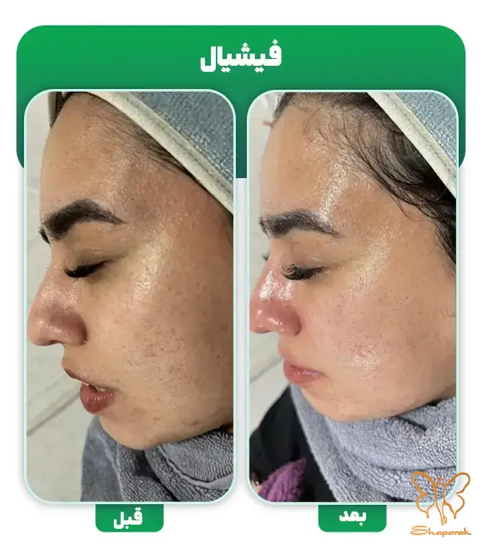 فیشیال تخصصی پوست مشهد