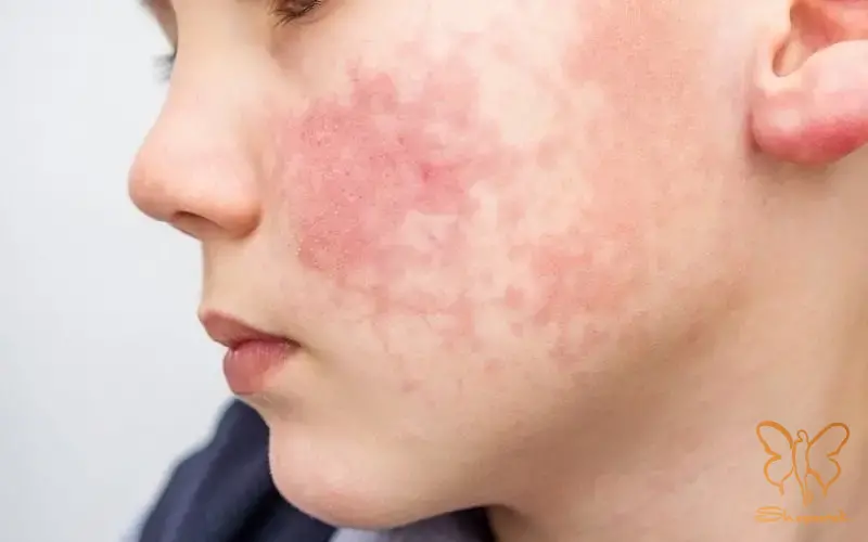 شایع ترین آ شایع ترین آ