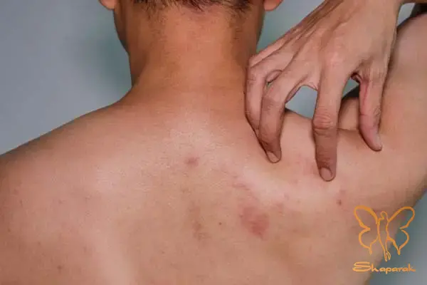 آیا سن و جنسیت در بروز آکنه بدن تأثیرگذار است