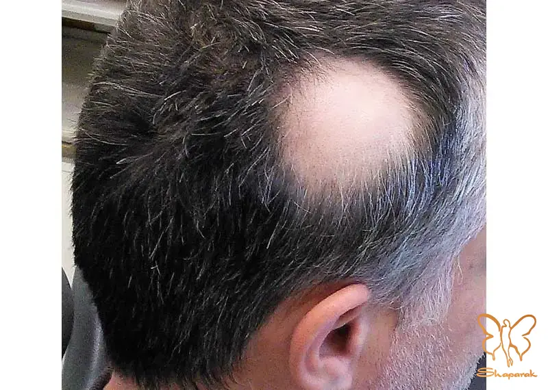ریزش موی سکهای