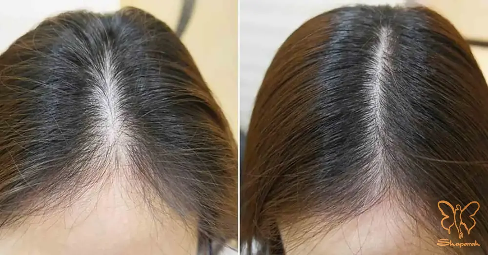 تأثیر مزوتراپی مو بر رنگدانه های مو تأثیر مزوتراپی مو بر رنگدانه های مو