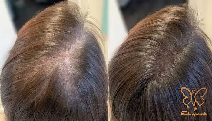 تأثیر تزریق پی آر اف بر رنگدانه های مو تأثیر تزریق پی آر اف بر رنگدانه های مو