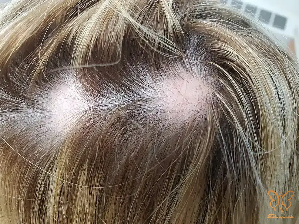 ریزش موی سکه ای آلوپسی آره آتا ریزش موی سکه ای آلوپسی آره آتا