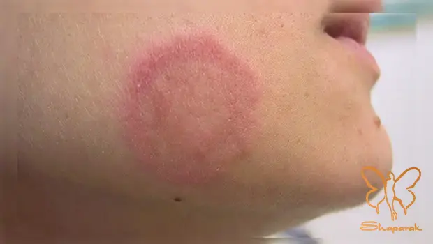 شایع ترین آ شایع ترین آ