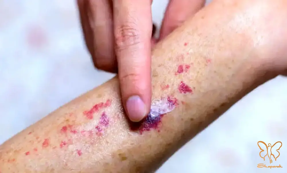 درمان های هپاتیت B و C در کلینیک شاپرک مشهد درمان های هپاتیت B و C در کلینیک شاپرک مشهد