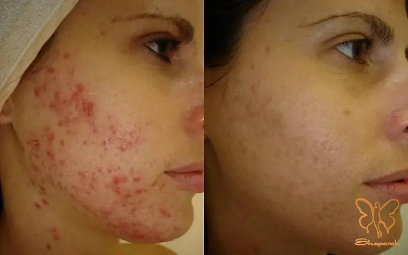 درمان جوش و آکنه فعال با دستگاه فوتونا