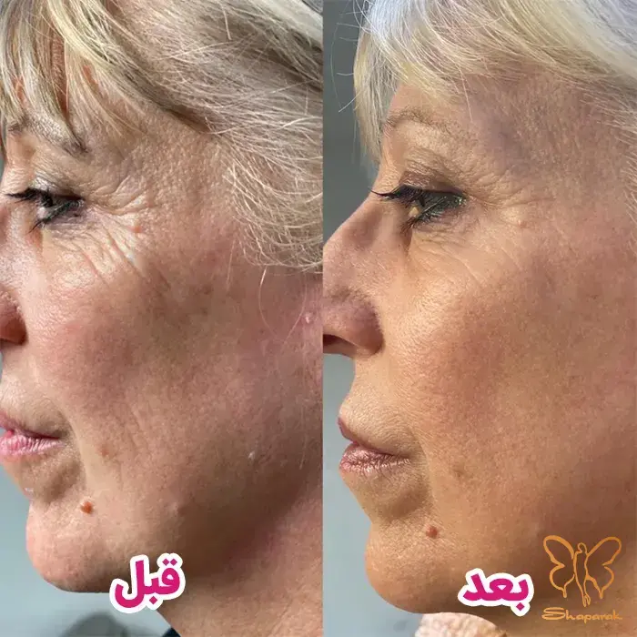 پروسترولین نچرال بی در مشهد NaturalB تمرکز بر جوانسازی و لیفت طبیعی