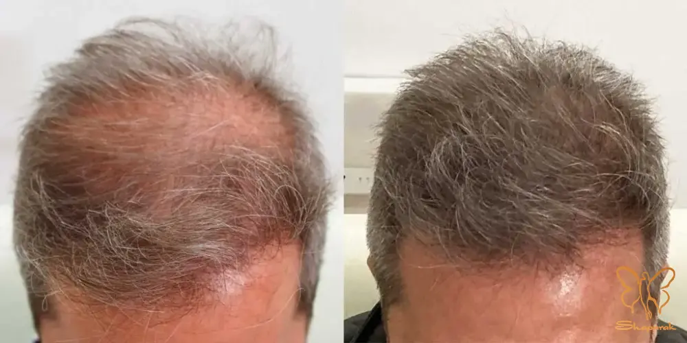 کلینیک تخصصی لیزر موهای زائد شاپرک طلایی مشهد کلینیک تخصصی لیزر موهای زائد شاپرک طلایی مشهد