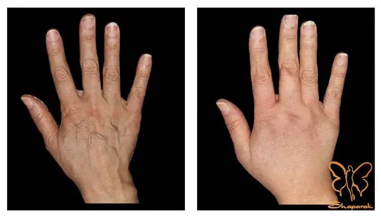 پی آر پی PRP یا پلاسمای غنی از پلاکت پی آر پی PRP یا پلاسمای غنی از پلاکت