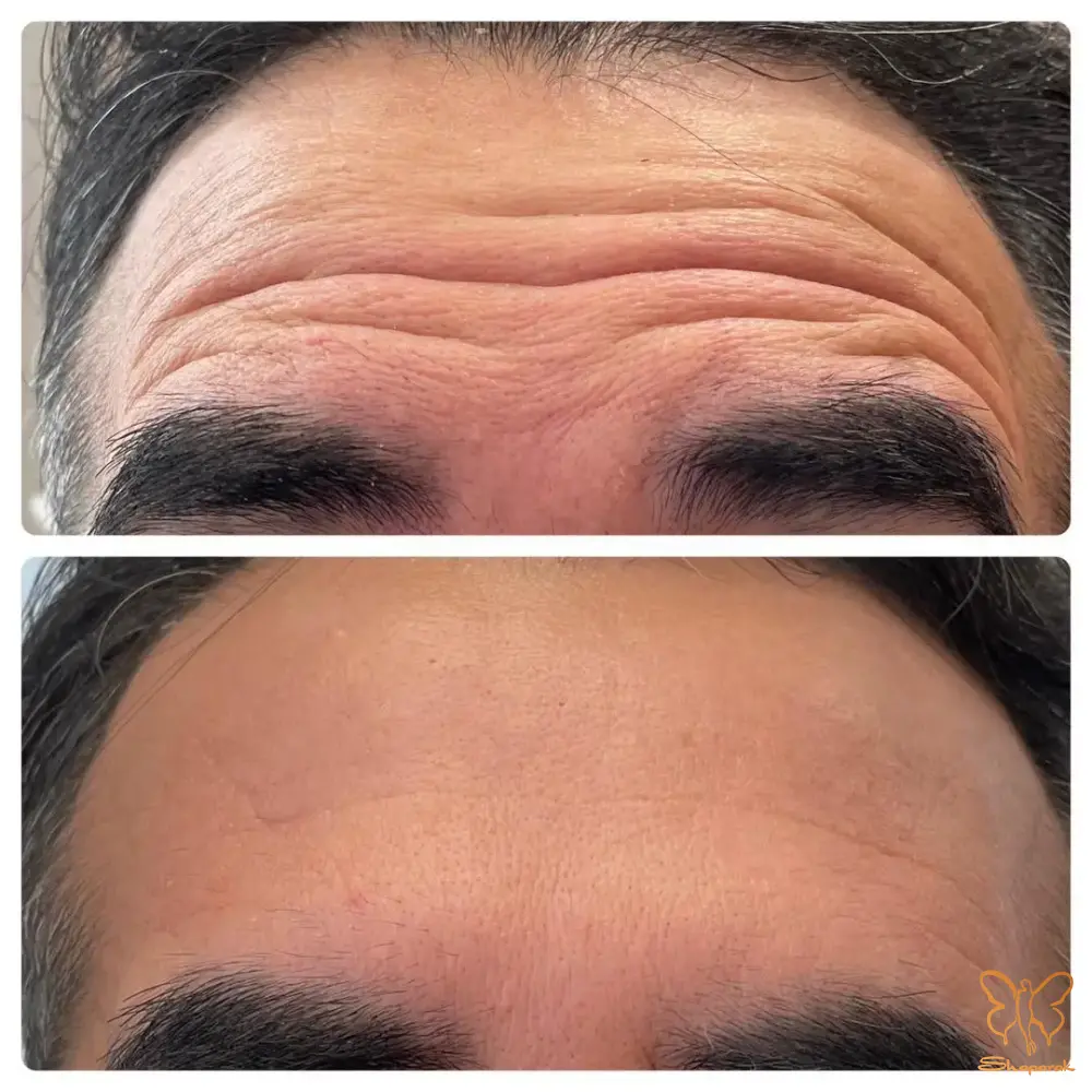 کاربردهای زیبایی و جوانسازی بوتاکس