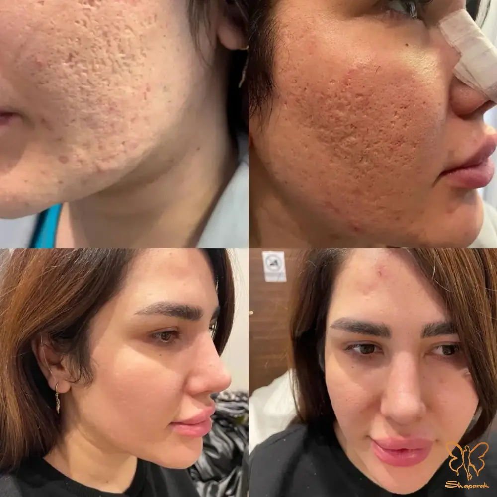 دستگاه CO2 فرکشنال دستگاه CO2 فرکشنال