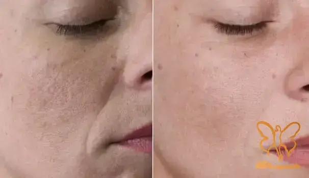 مزونیدلینگ صورت مشهد برای جوانسازی و رفع لک و اسکار