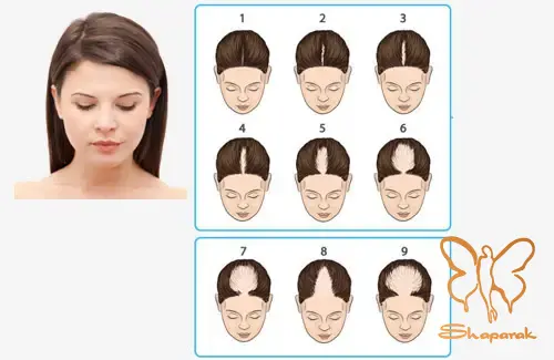 ریزش مو با الگوی زنانه ریزش مو به صورت پراکنده