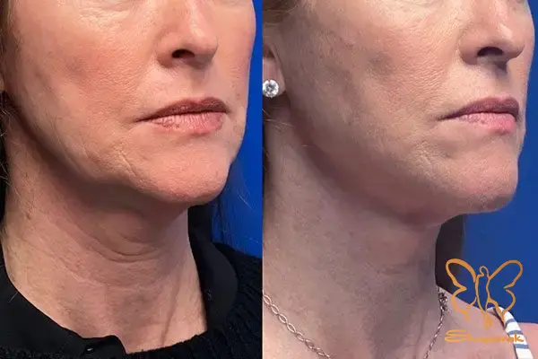 نخ های مونو PDO مشهد نخ های مونو PDO مشهد