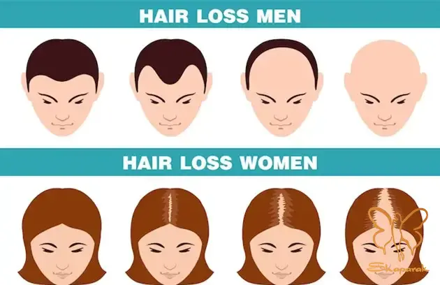  ریزش موی آلوپسی آندروژنیک