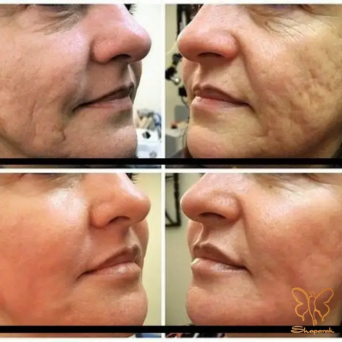 آراف RF فرکشنال مشهد آراف RF فرکشنال مشهد