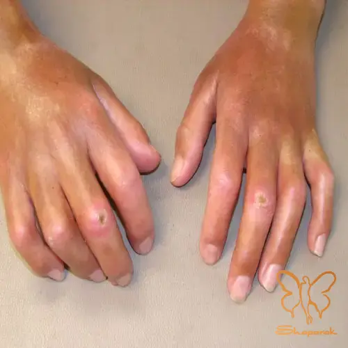 پدیده رینود Raynauds Phenomenon پدیده رینود Raynauds Phenomenon