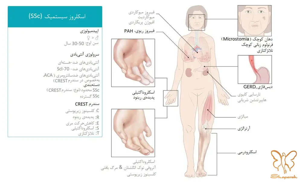 انواع اصلی اسکلرودرمی موضعی در مقابل سیستمیک انواع اصلی اسکلرودرمی موضعی در مقابل سیستمیک
