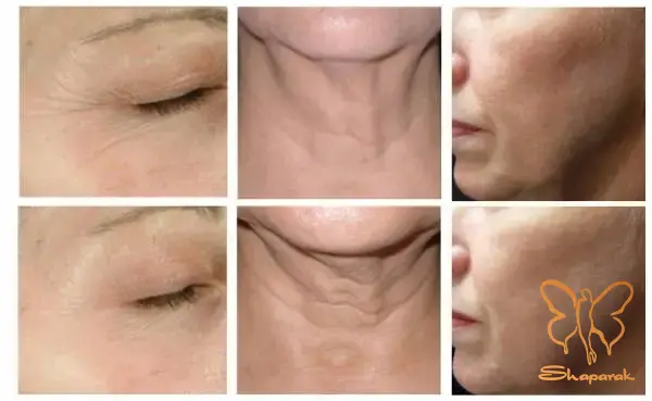 هایفو دابلو گلد پریمیوم مشهد هایفو دابلو گلد پریمیوم مشهد