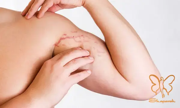 مرحله حاد Striae Rubrae