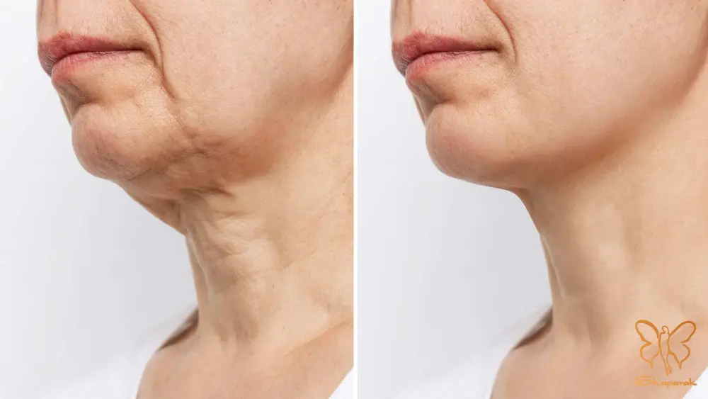 پی آر پی PRP یا پلاسمای غنی از پلاکت پی آر پی PRP یا پلاسمای غنی از پلاکت