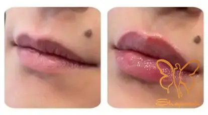 جوانسازی لب و رفع تیرگی جوانسازی لب و رفع تیرگی