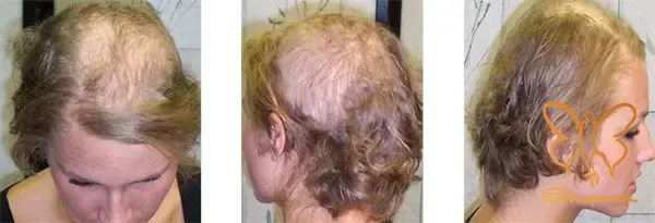 سندروم تریکوتیلومانیا Trichotillomania یا Hairpulling disorder