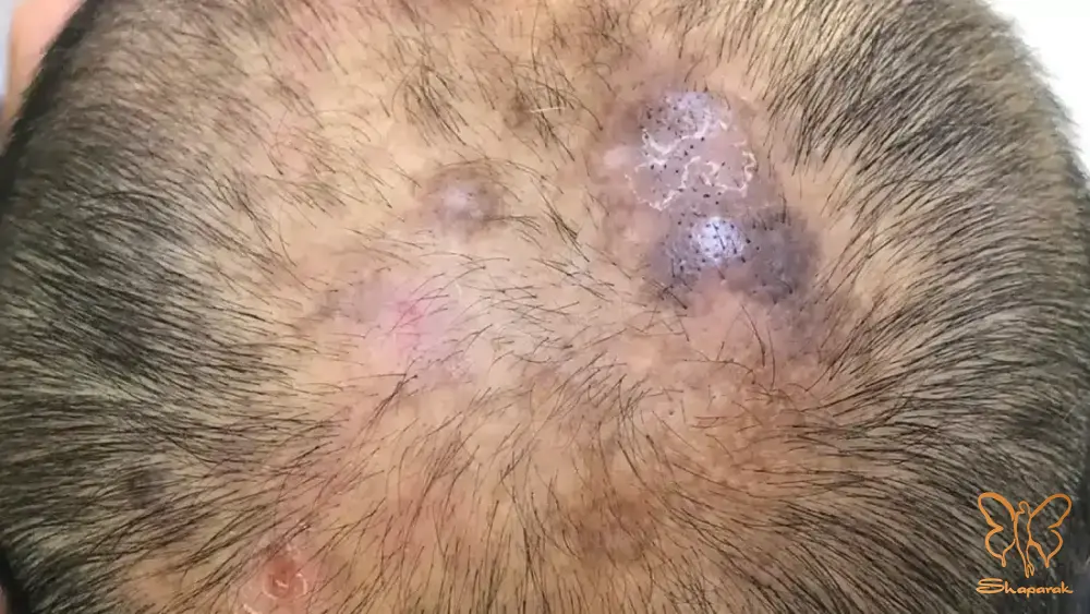 آلوپسی سیکاتریسیل&nbsp;تخریب دائمی فولیکول های مو