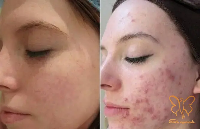 دستگاه فوتونا آکنه در مشهد دستگاه فوتونا آکنه در مشهد