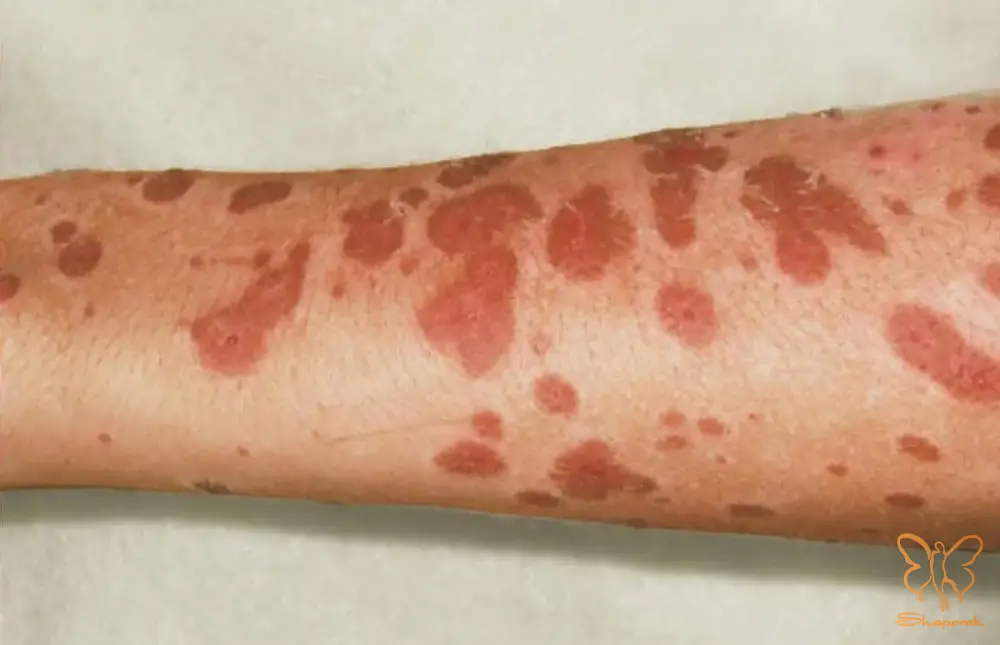 مرحله دوم بروز فاجعه پوستی