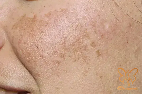 ملاسما Melasma 