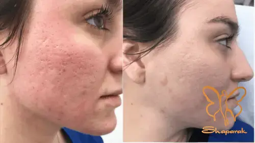 میکرونیدلینگ صورت در مشهد میکرونیدلینگ صورت در مشهد