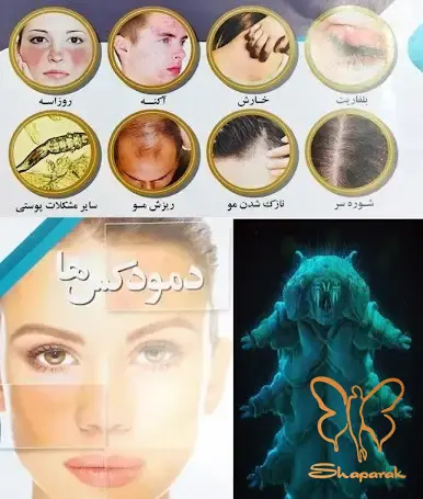 دمودیکوزیس درمان دارد رویکردهای نوین درمانی در کلینیک شاپرک مشهد&nbsp;