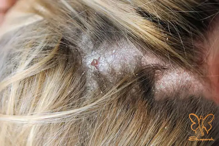 تینه آ کاپیتیس&nbsp;tinea capitis قارچ پوست سر