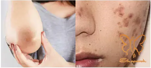 لک پس از التهاب PIH