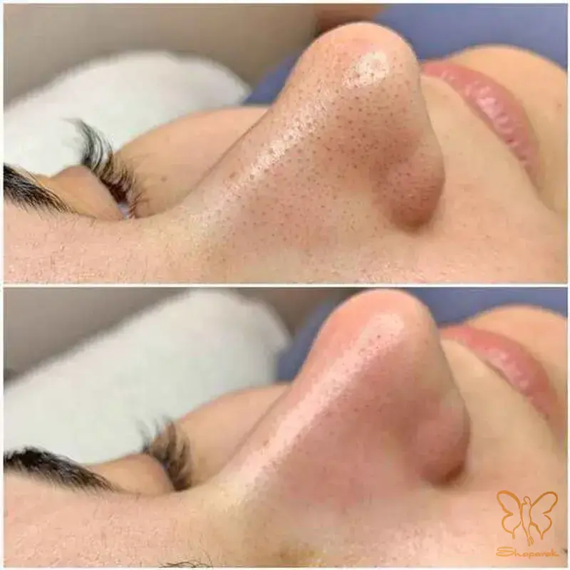 پاکسازی های تخصصی پوست در مشهد پاکسازی های تخصصی پوست در مشهد