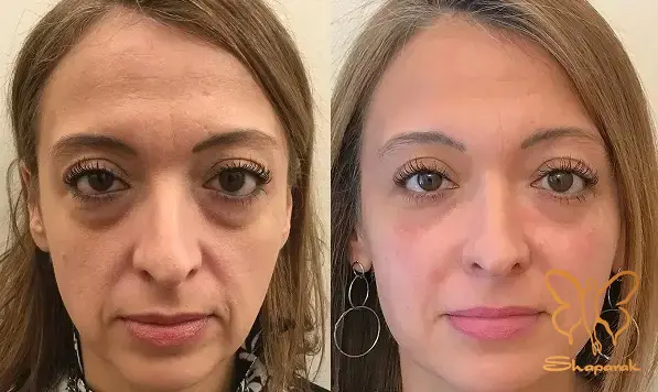 تزریق ژل در کلینیک شاپرک مشهد&nbsp;بازگرداندن شادابی و زیبایی به چهره