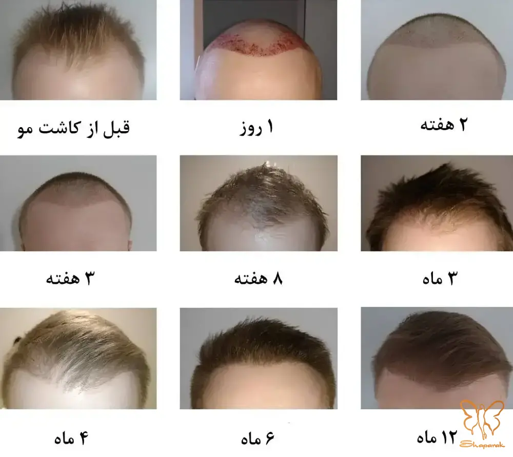 از ریزش شوک تا رشد دائمی جدول زمانی رشد مو در کلینیک شاپرک مشهد 