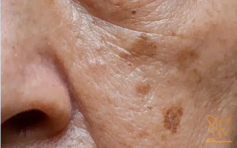 لنتیگو یا لکهای پیری LentiginesAge Spots