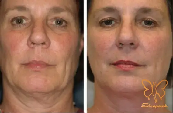 میکرونیدلینگ جوانسازی صورت در مشهد