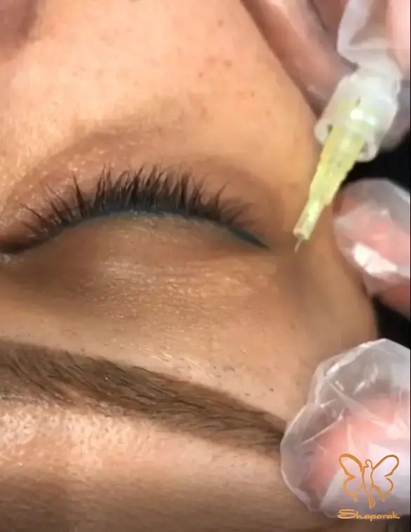 معجزه مزوتراپی و فیلر زیر چشم در کلینیک شاپرک طلایی