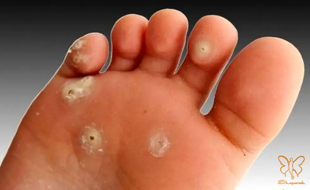 تفاوت میخچه سخت و نرم دو چهره یک عارضه در مشهد تفاوت میخچه سخت و نرم دو چهره یک عارضه در مشهد