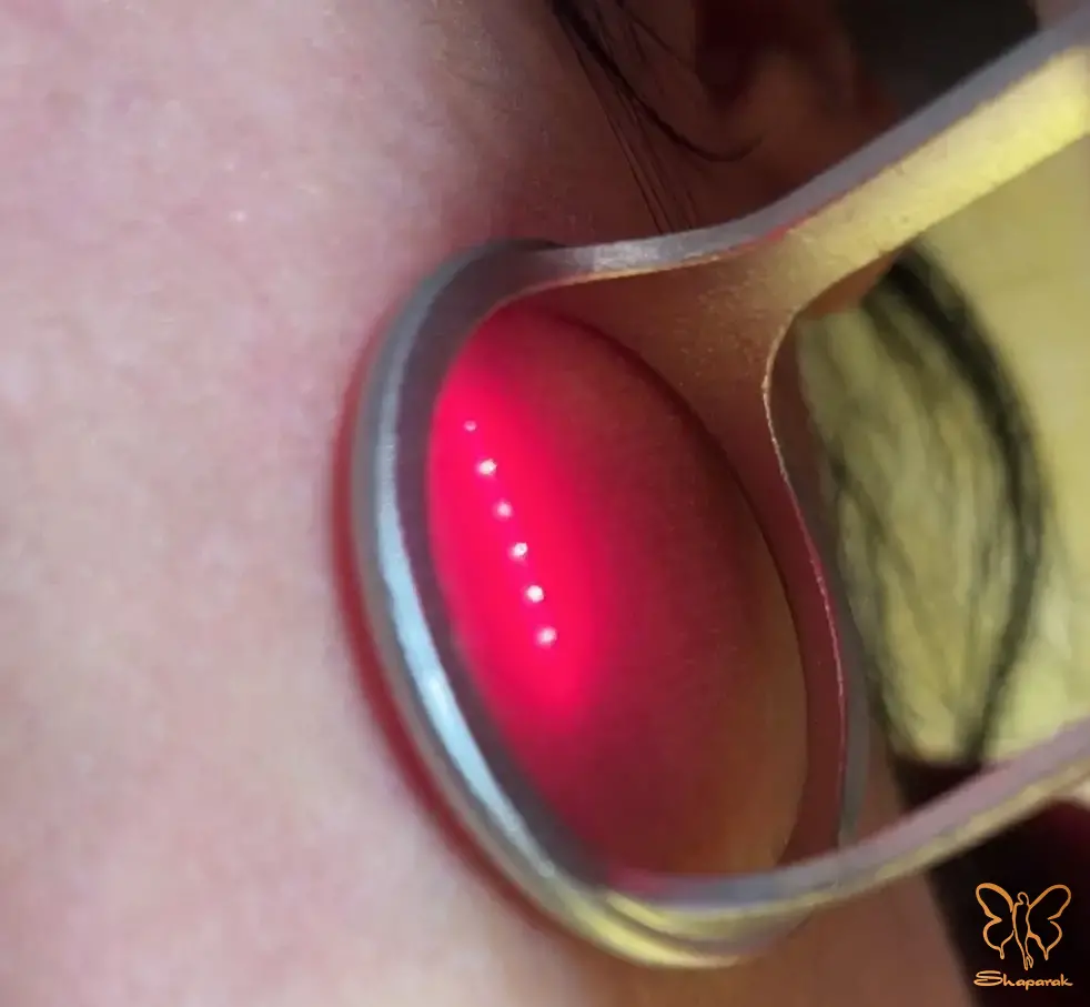 درمان اسکارهای عمیق آکنه درمان اسکارهای عمیق آکنه