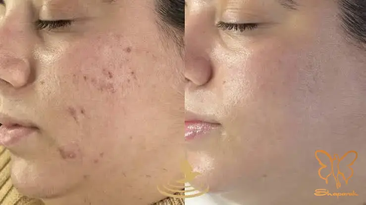 میکرونیدلینگ صورت با PRP میکرونیدلینگ صورت با PRP