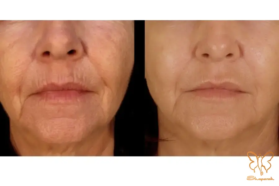 چرا ترکیب لیزر و مزوتراپی کامل ترین درمان است چرا ترکیب لیزر و مزوتراپی کامل ترین درمان است