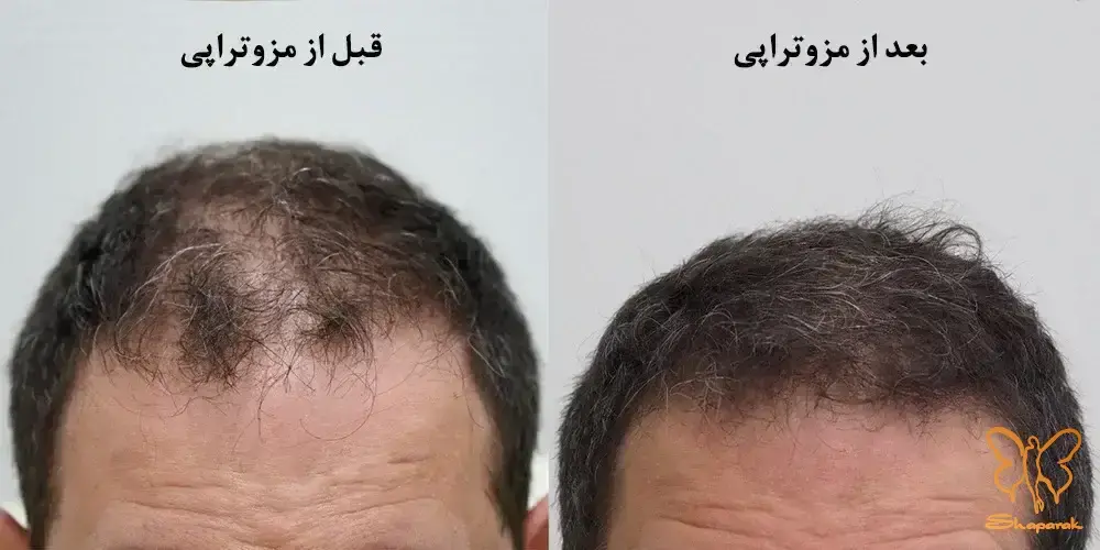 مزوتراپی پوست و مو مشهد