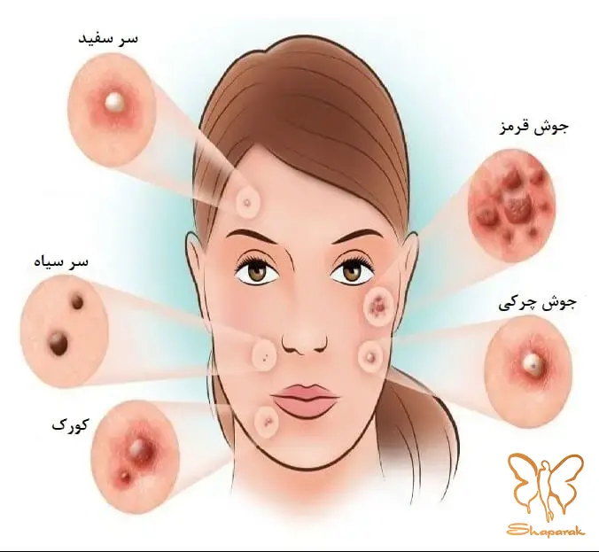 محل قرارگیری جوشها نقشه راه درمان در مشهد